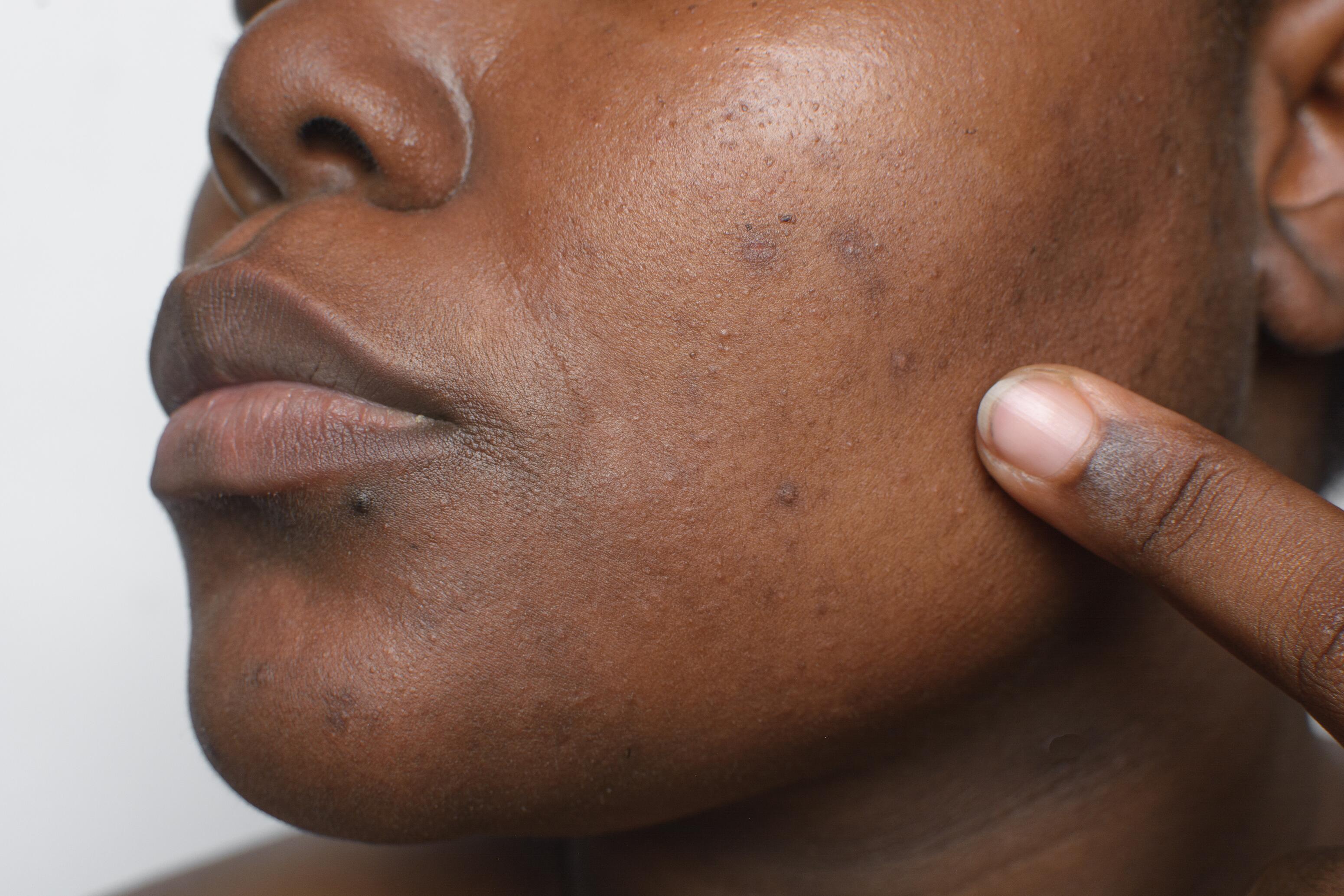 Active acne lesions